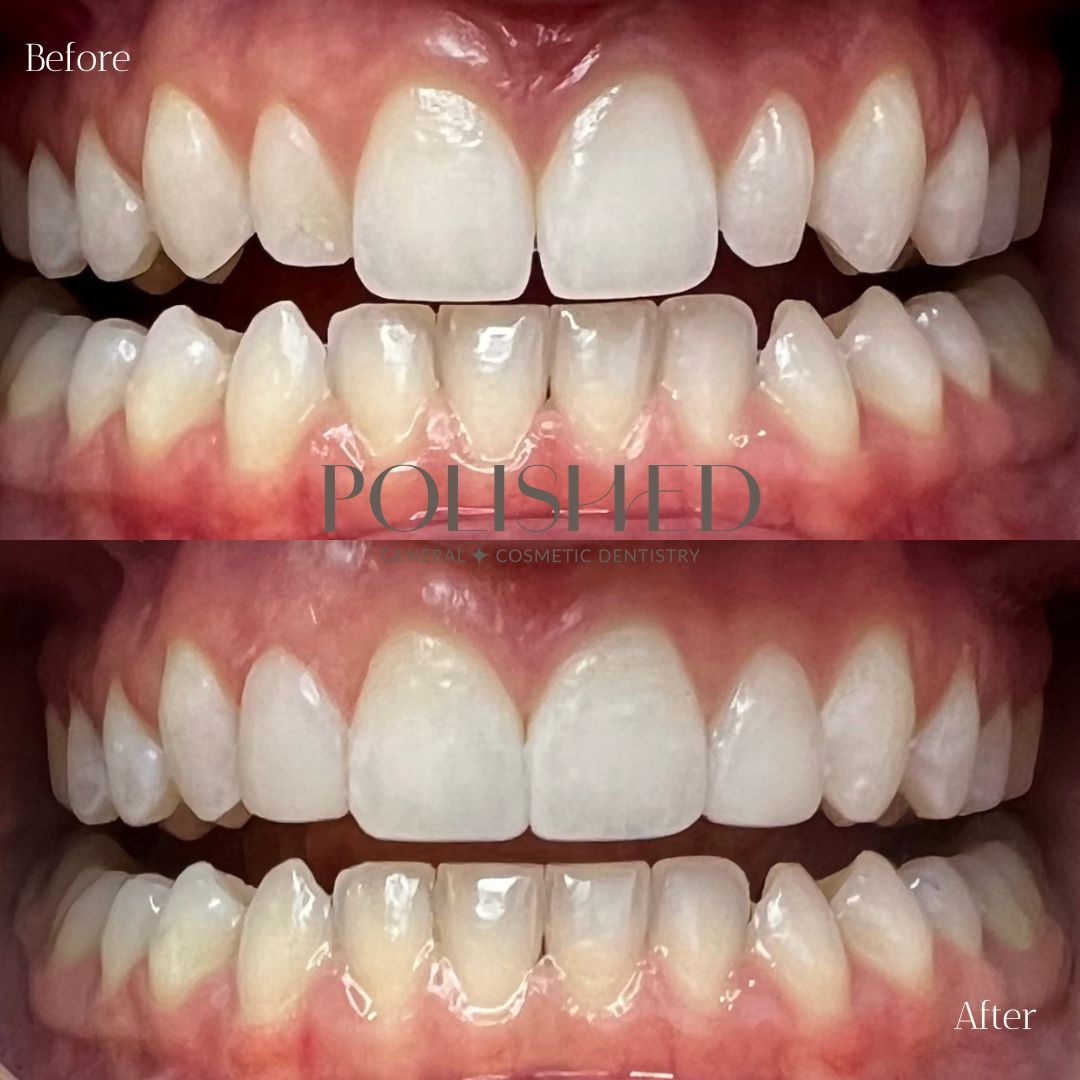 Polished B n A's (5)